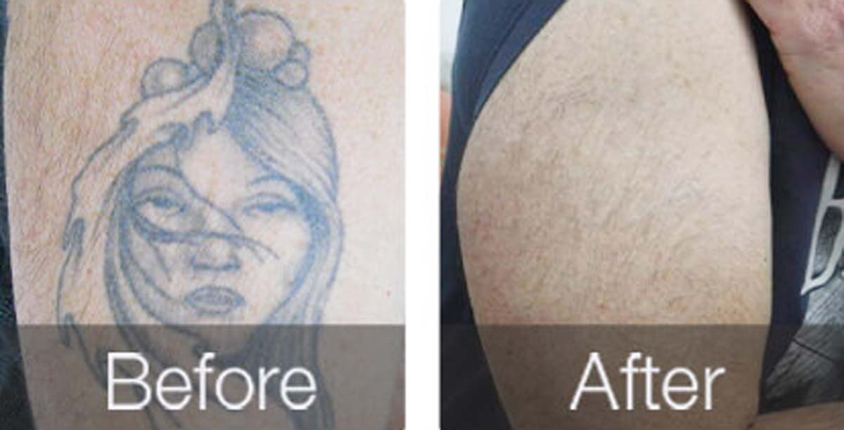 before-after-01