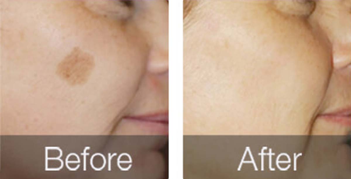 before-after-02