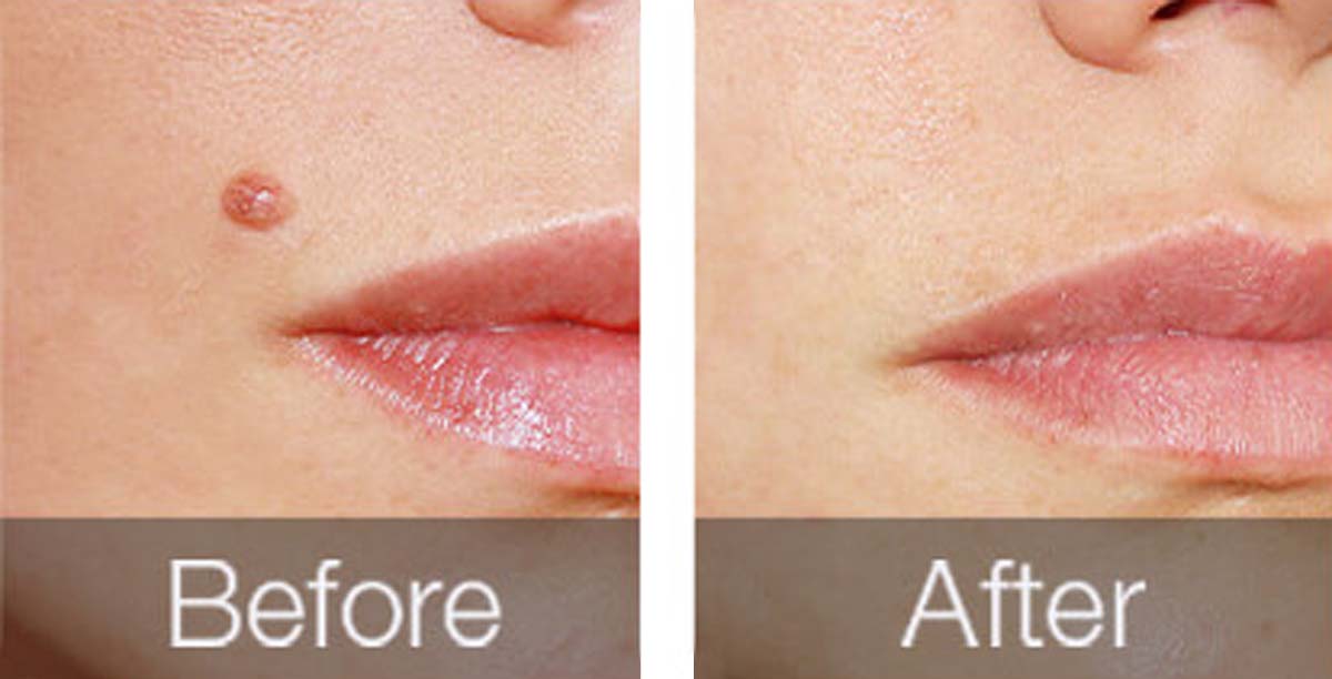 before-after-04