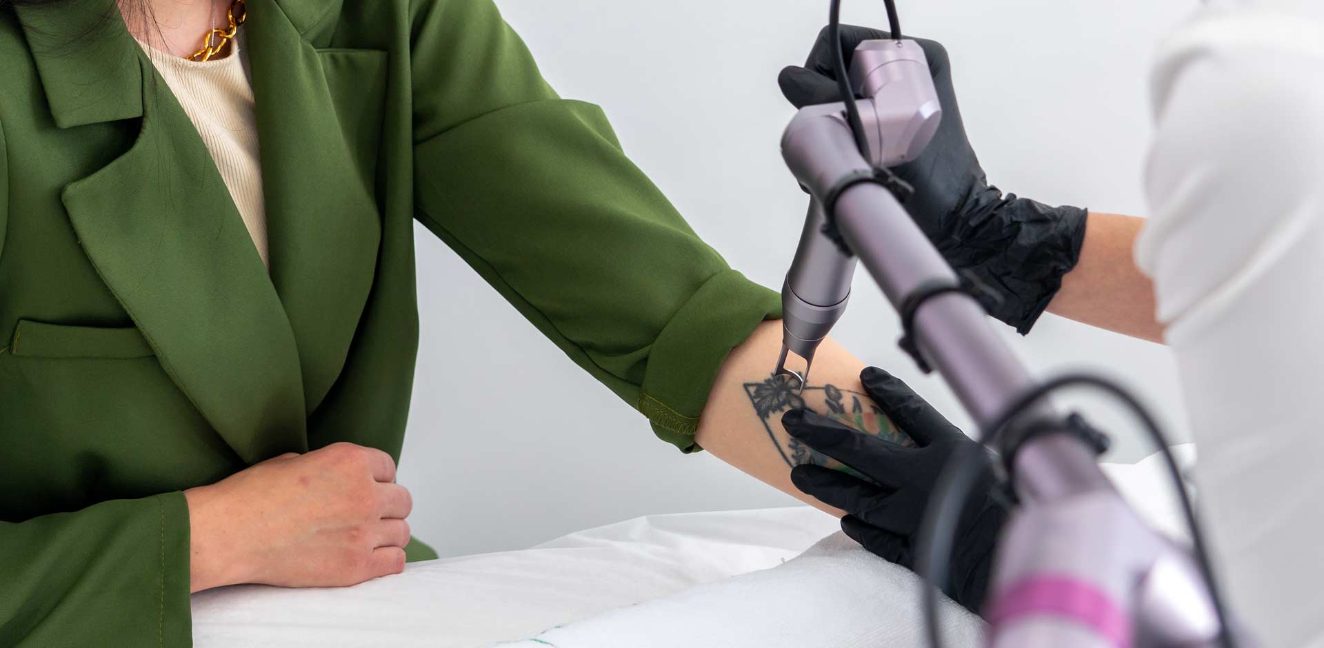 Tattoo-Removal